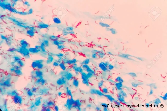 Микобактерии туберкулеза (палочки Коха) под микроскопом, окрашивание по Цилю-Нильсену (извините за идиота из фотобанки, хороших картиночек сейчас не купишь :С)
